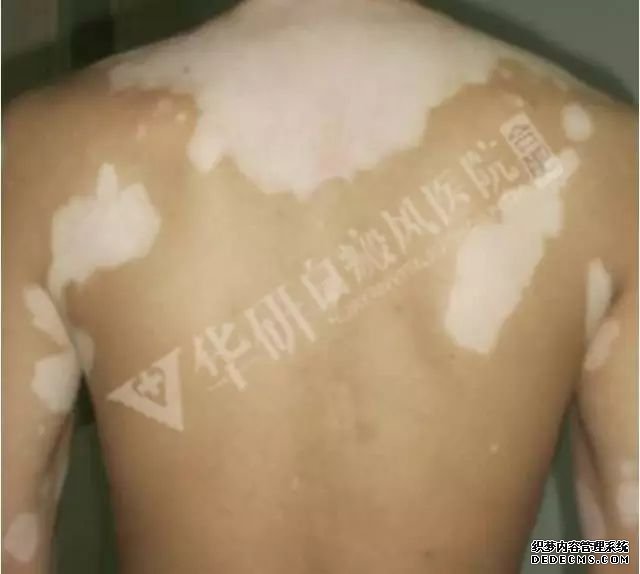 背后一些不规则的圆斑是白癜风吗